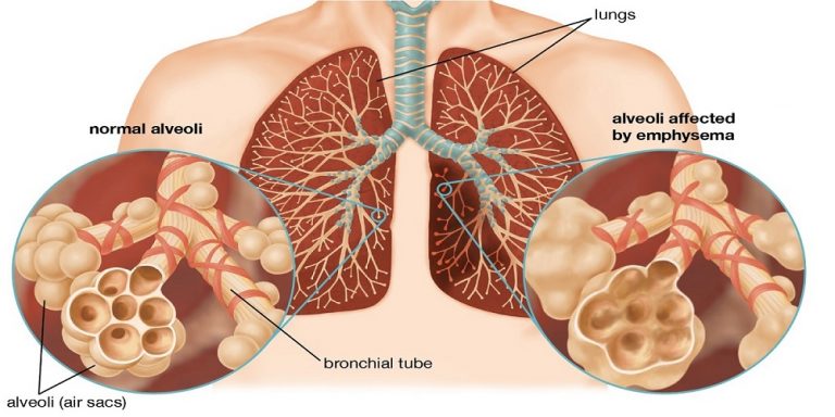 Boala pulmonară obstructivă cronică se poate trata cu ulei de canabis